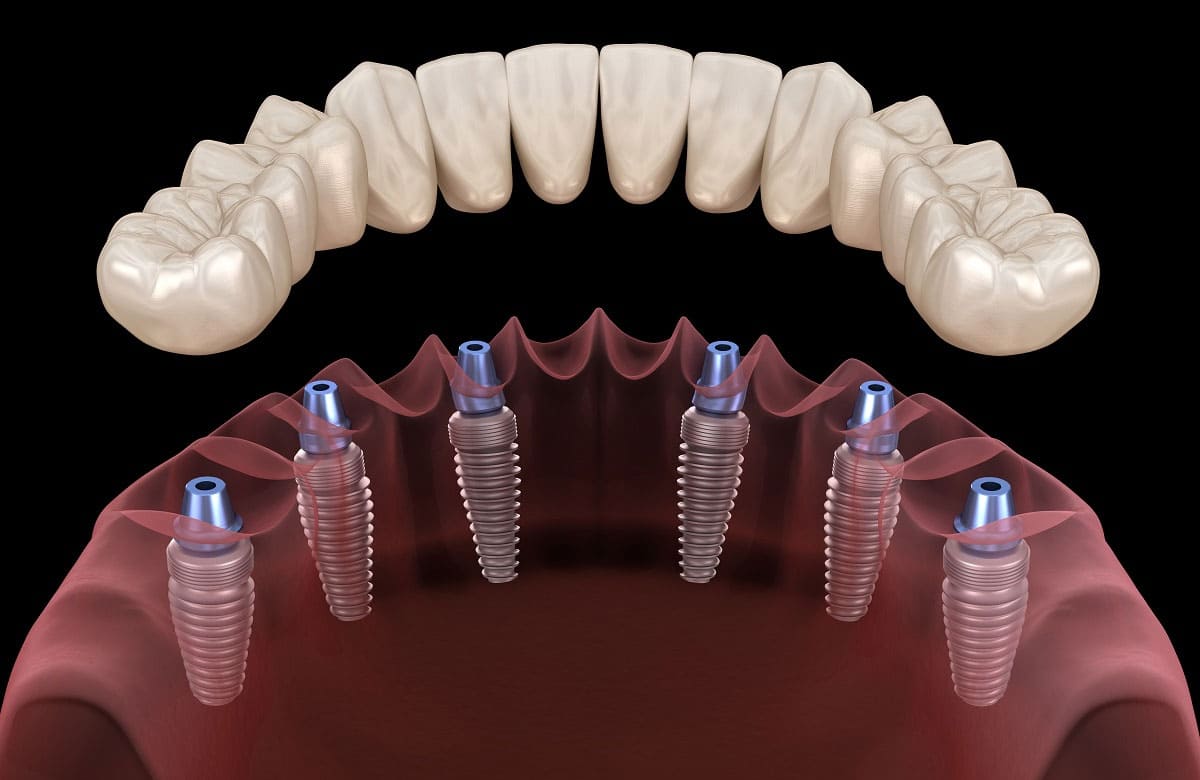 Имплантация зубов all on 6. Дентальные имплантаты all on 6. Мостовидный протез на 6 имплантах. Имплантат Paltop.